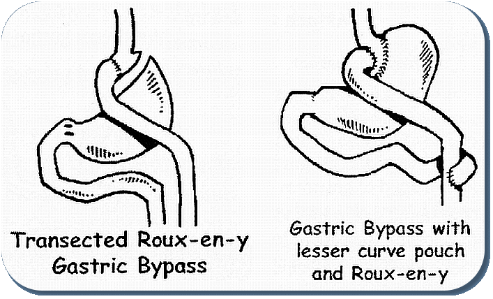 Gastroplasty Duodenal Switch Diet